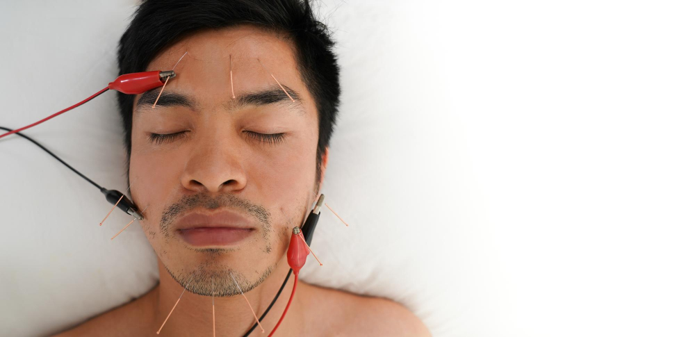 Acupuncture for Migraines