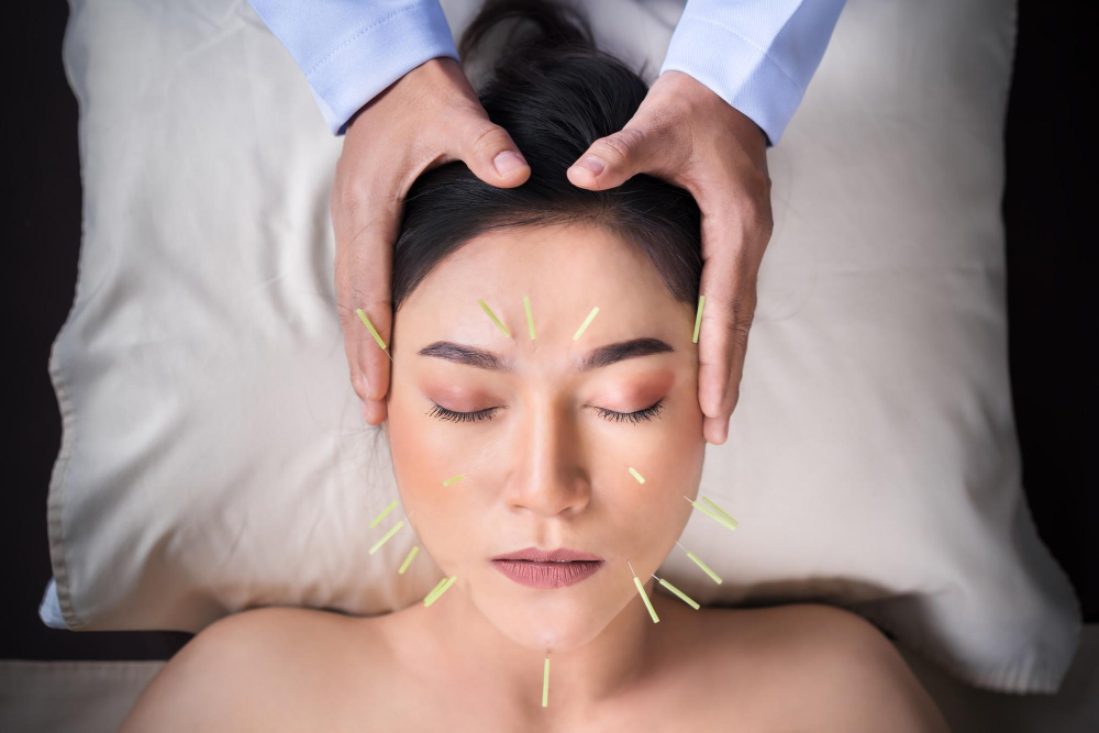 Acupuncture for Migraines