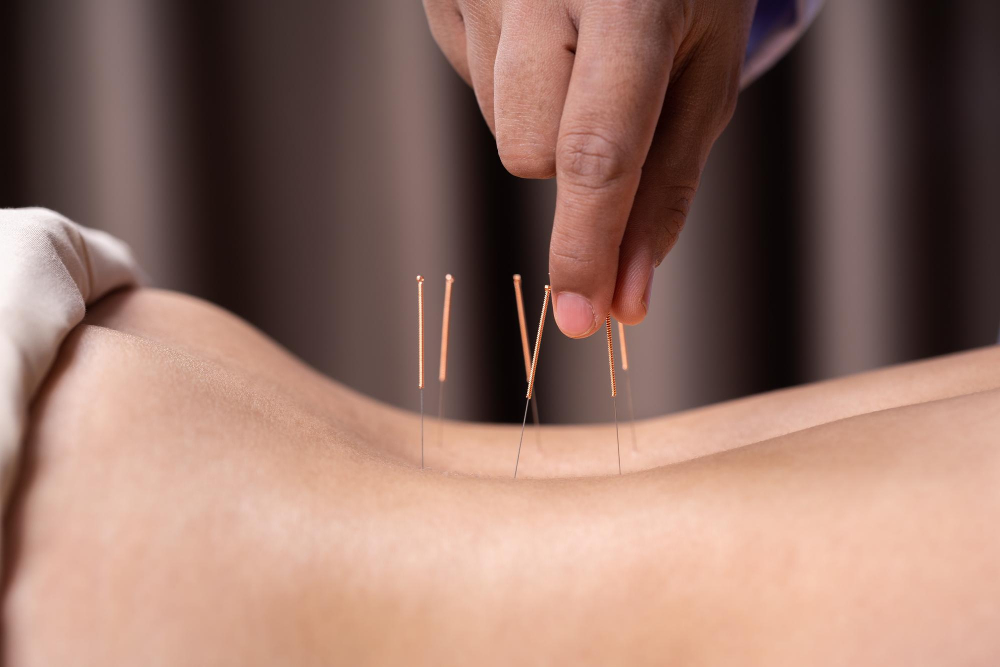  Acupuncture 
