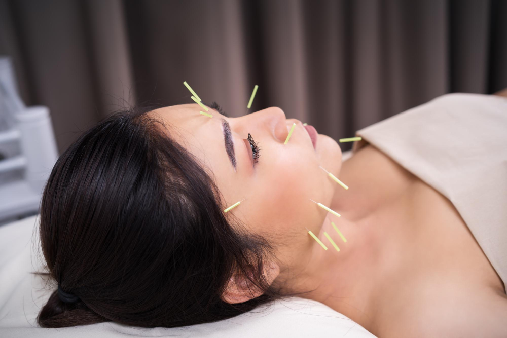 Acupuncture for Migraines