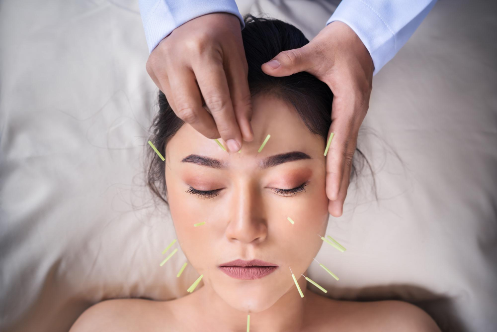Acupuncture for Migraines