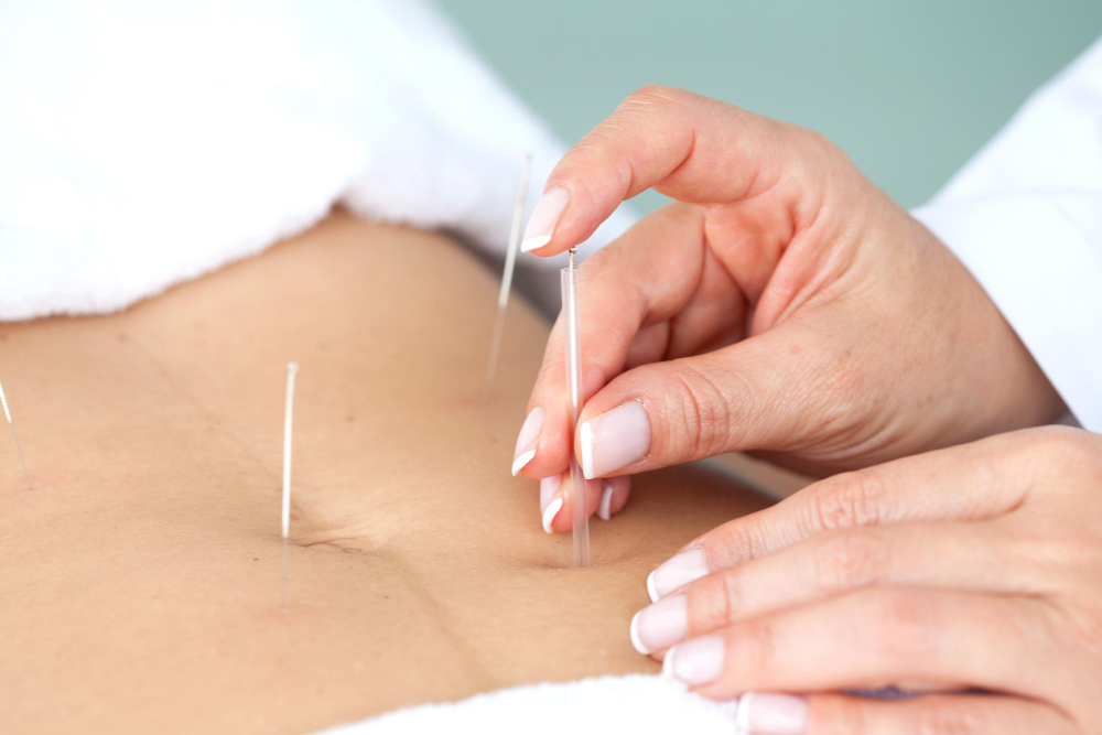 Acupuncture for Digestion