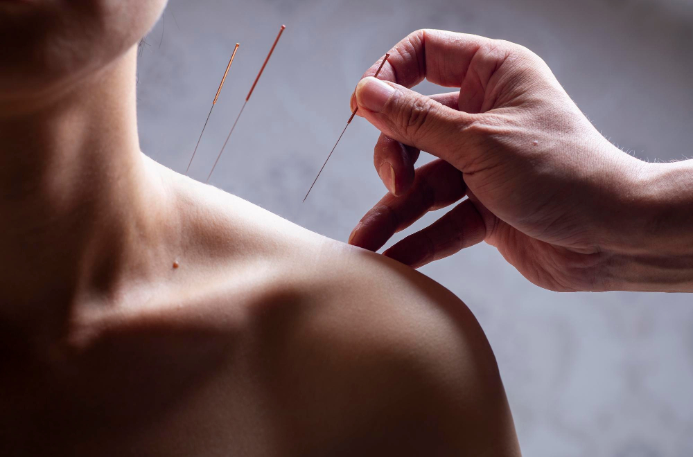  Acupuncture 