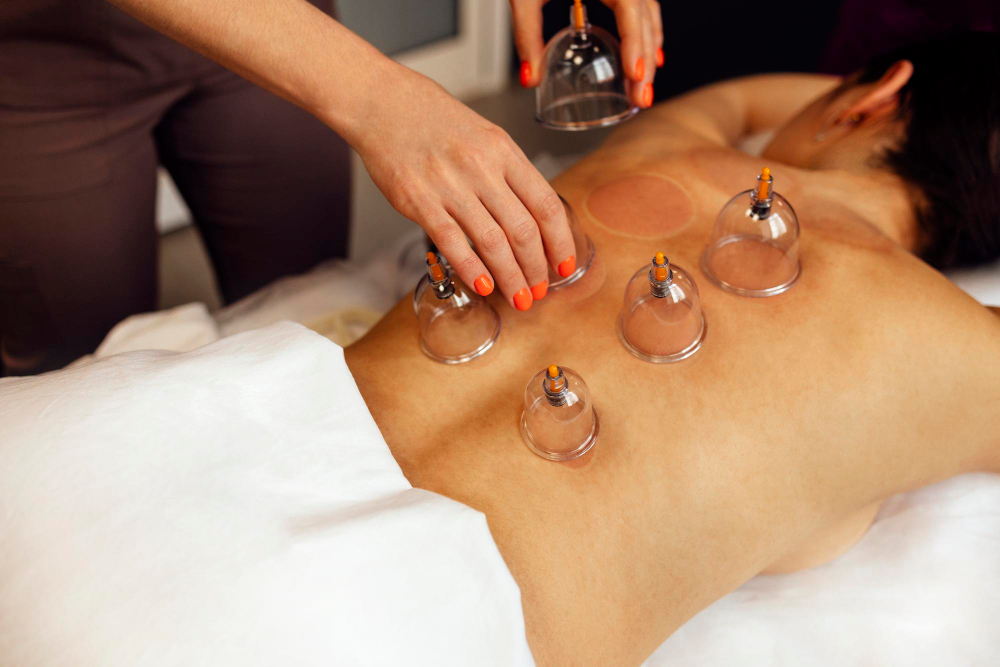 Cupping Therapy Services