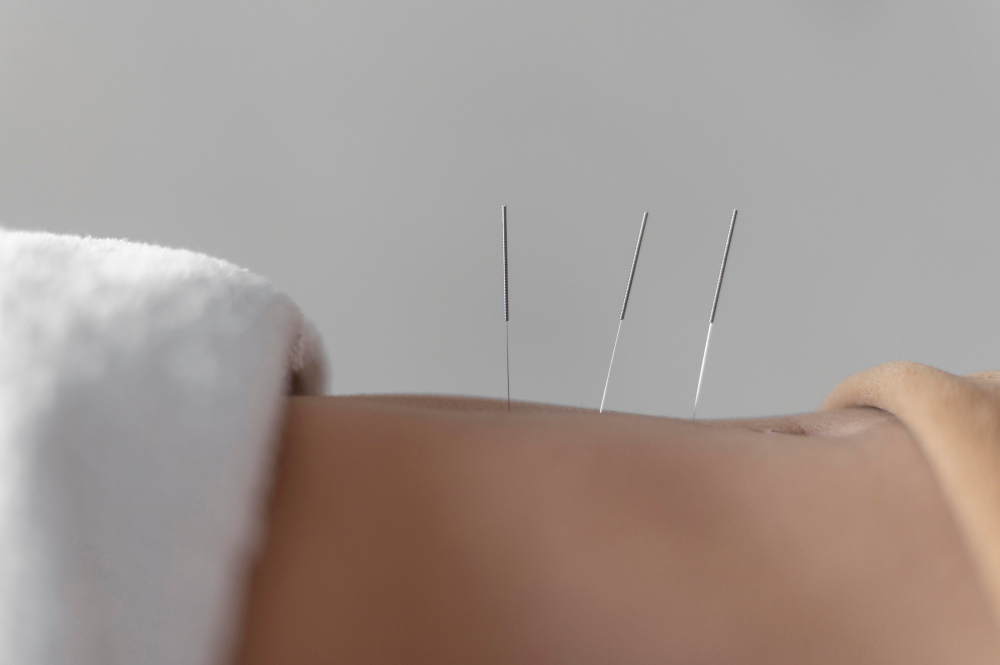 Acupuncture for Chronic Fatigue