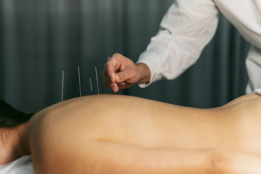  Acupuncture 