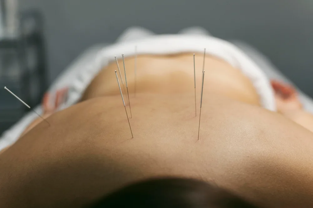 Acupunture-image