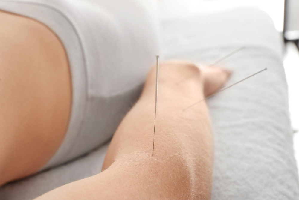  Acupuncture 