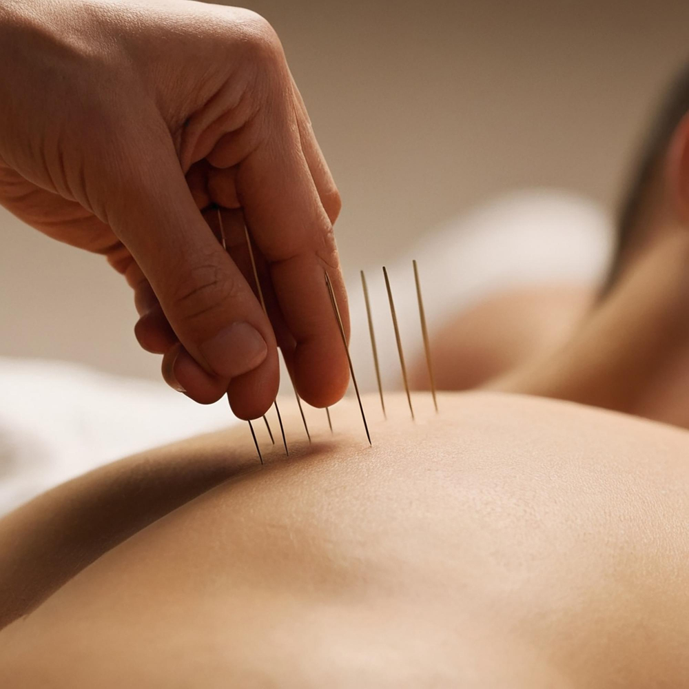  Acupuncture 