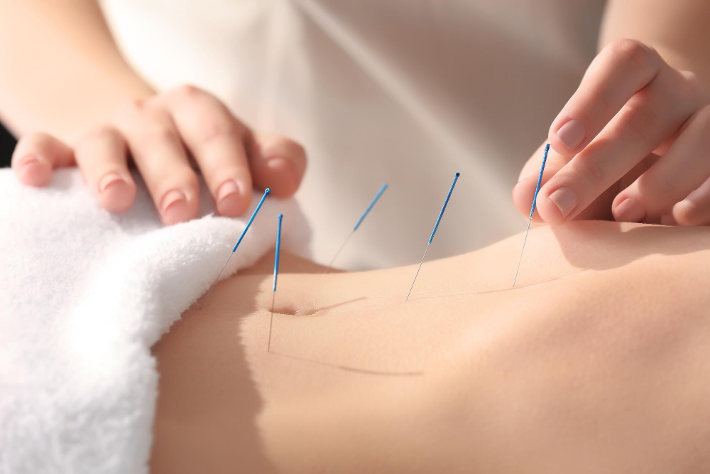 Acupuncture for Digestion