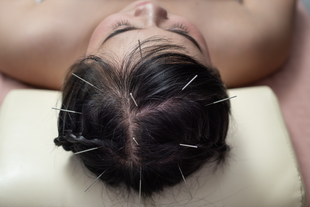 Acupuncture for Migraines