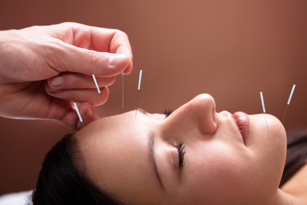  Acupuncture 