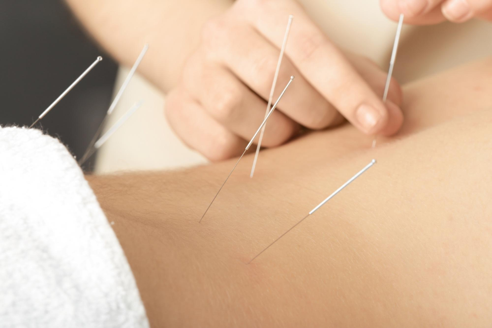  Acupuncture 