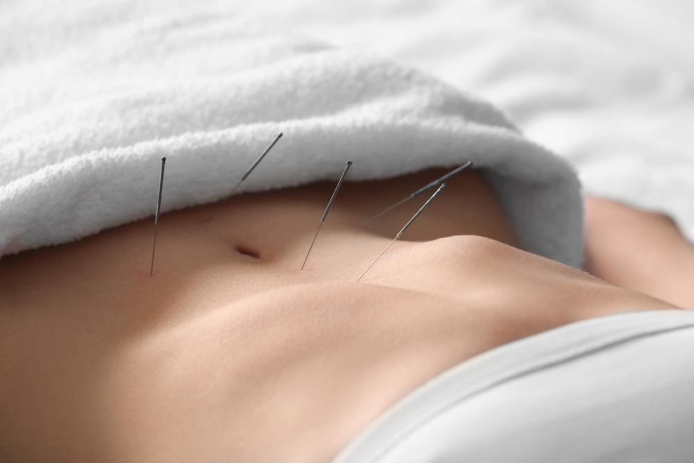  Acupuncture 