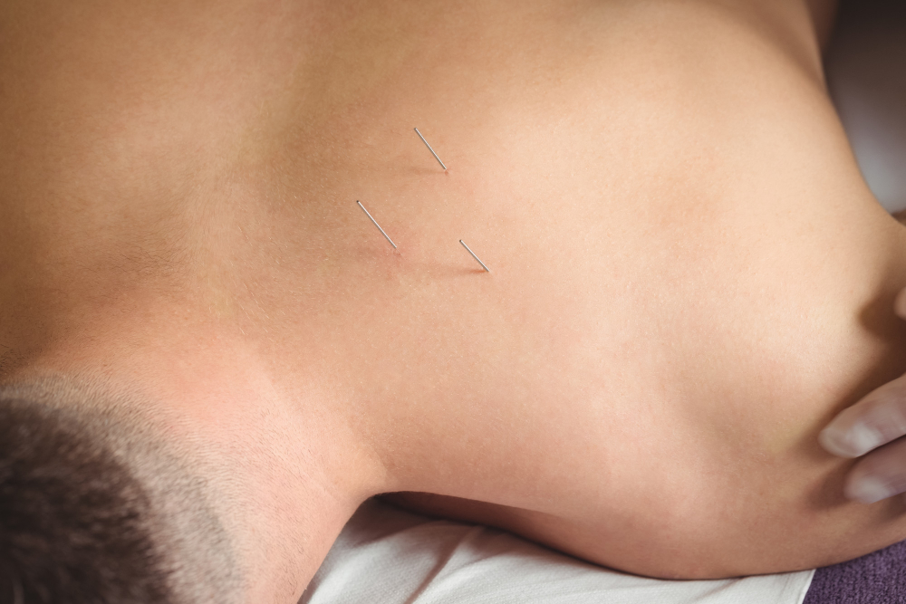 Acupuncture for Chronic Fatigue