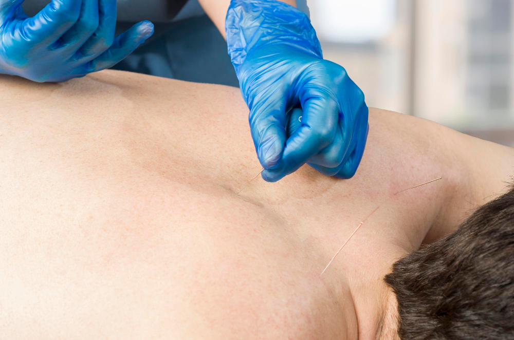 Acupuncture for Chronic Fatigue