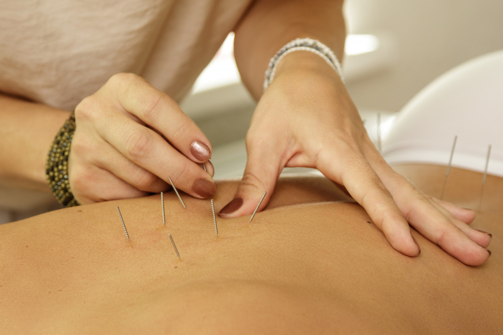 Acupuncture for Chronic Fatigue