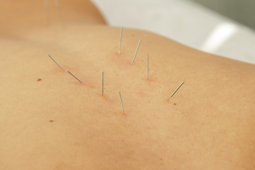 Acupuncture for Chronic Fatigue