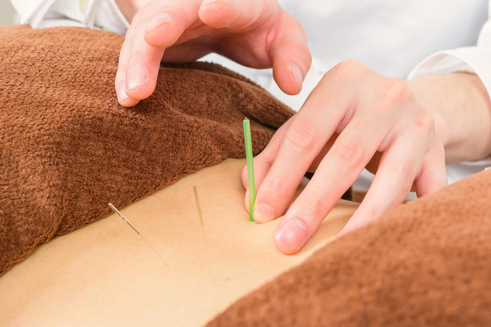 Acupuncture for Digestion