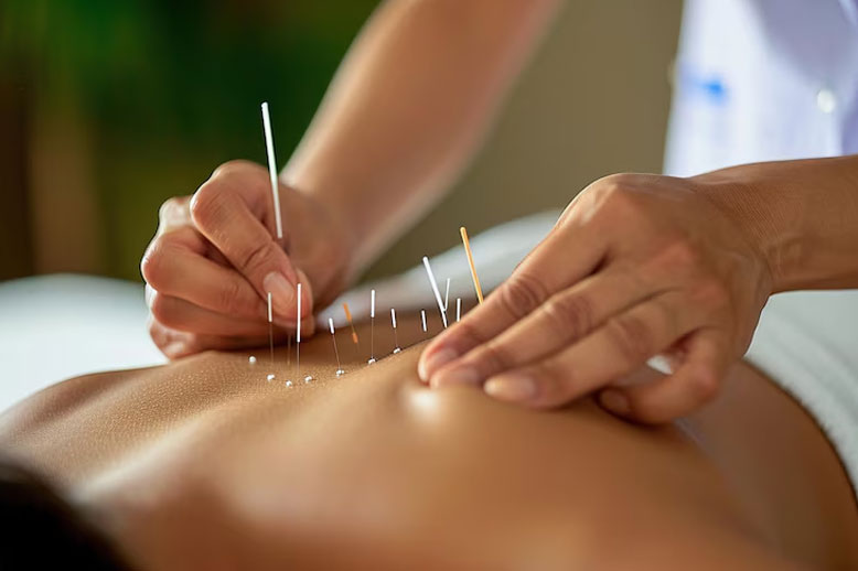 Acupuncture-Therapy-img