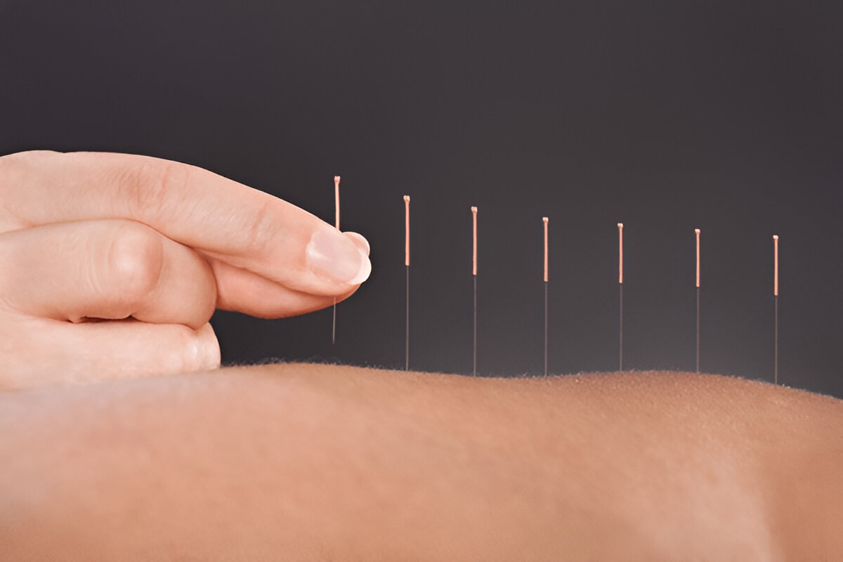 What Is Acupuncture? How It Works and What to Expect
