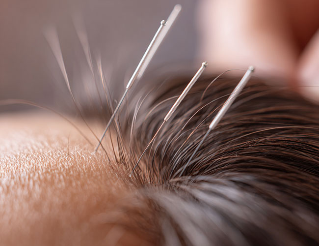 Acupuncture-Service-for-Sensory-System