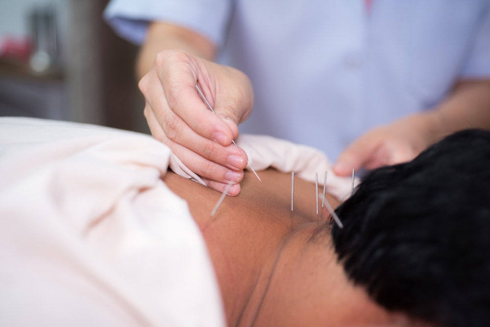 Acupuncture for Neck Pain