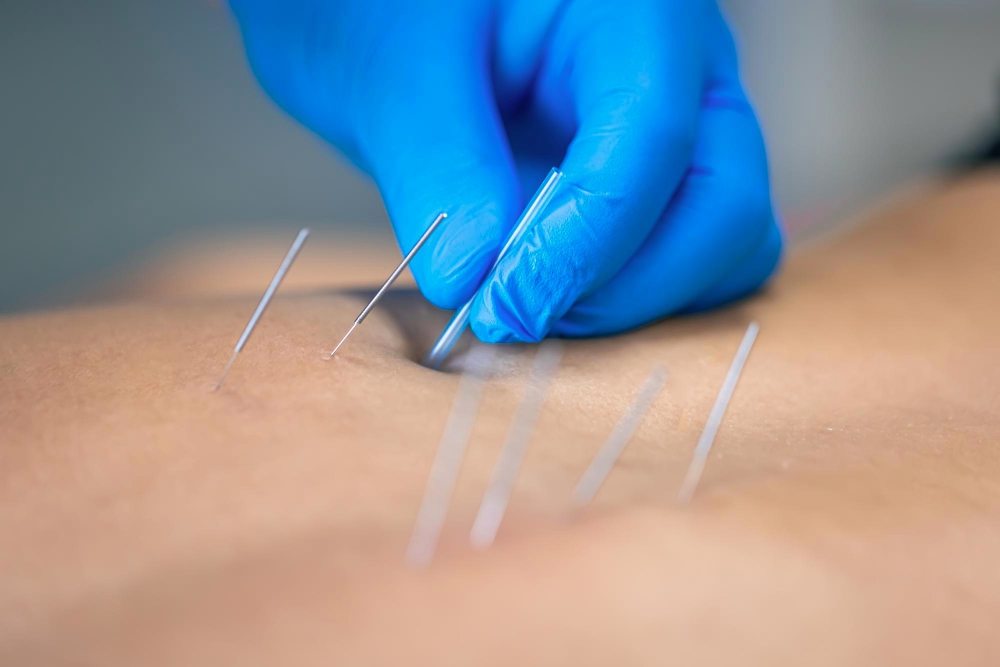 Advanced Acupuncture